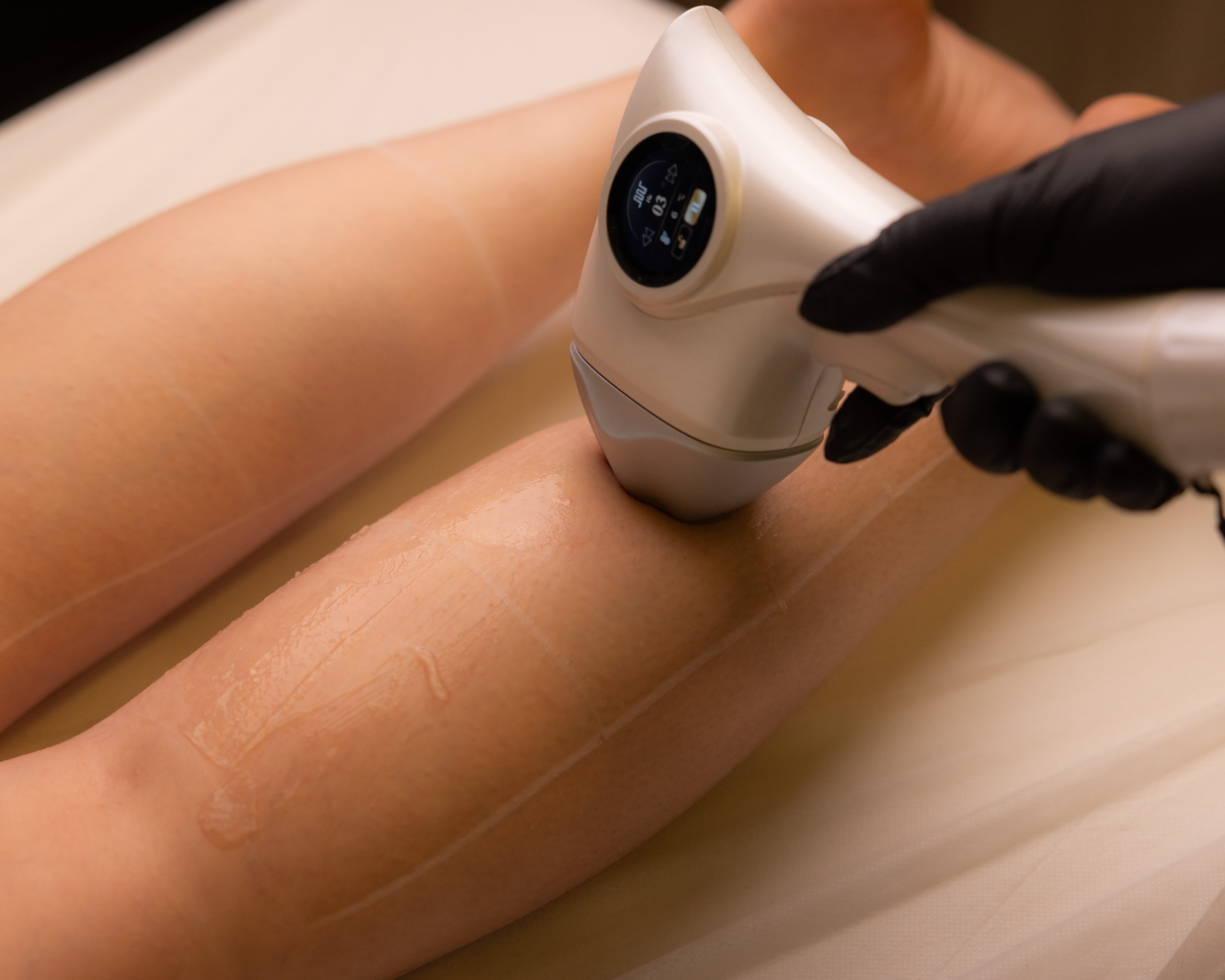 Laser Hair Removal